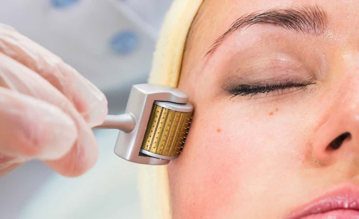 What are the risks of microneedling?  How to avoid