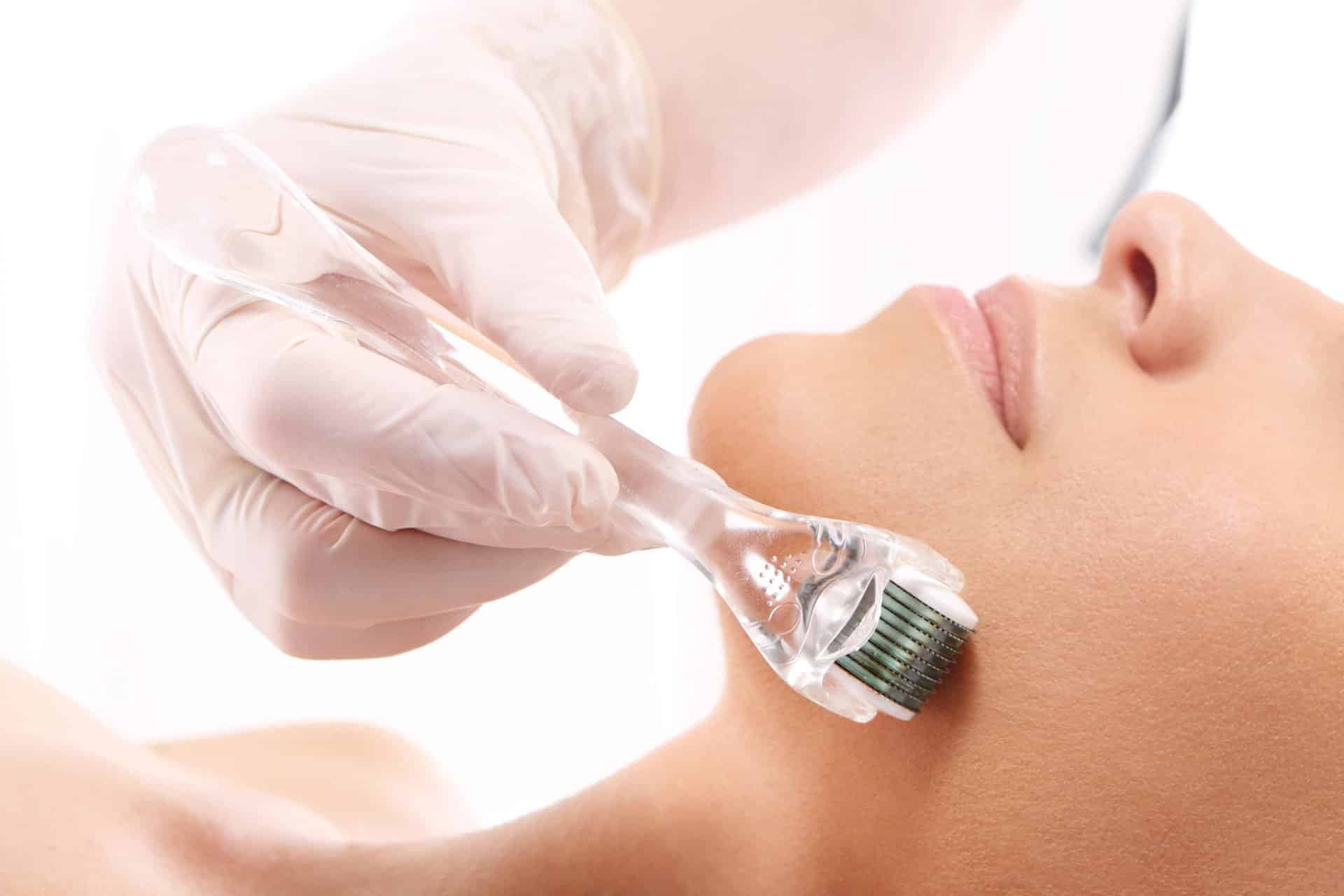 What is microneedling for?  Benefits and contraindications