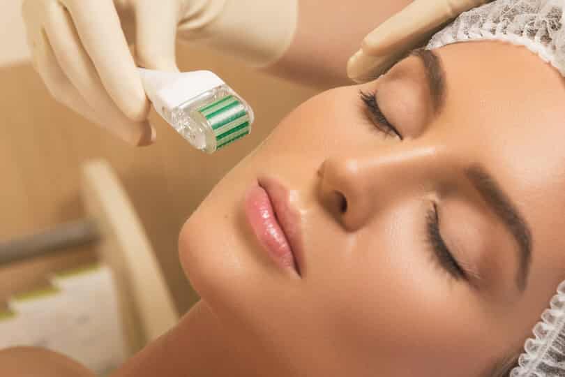 What is microneedling for?  Main benefits