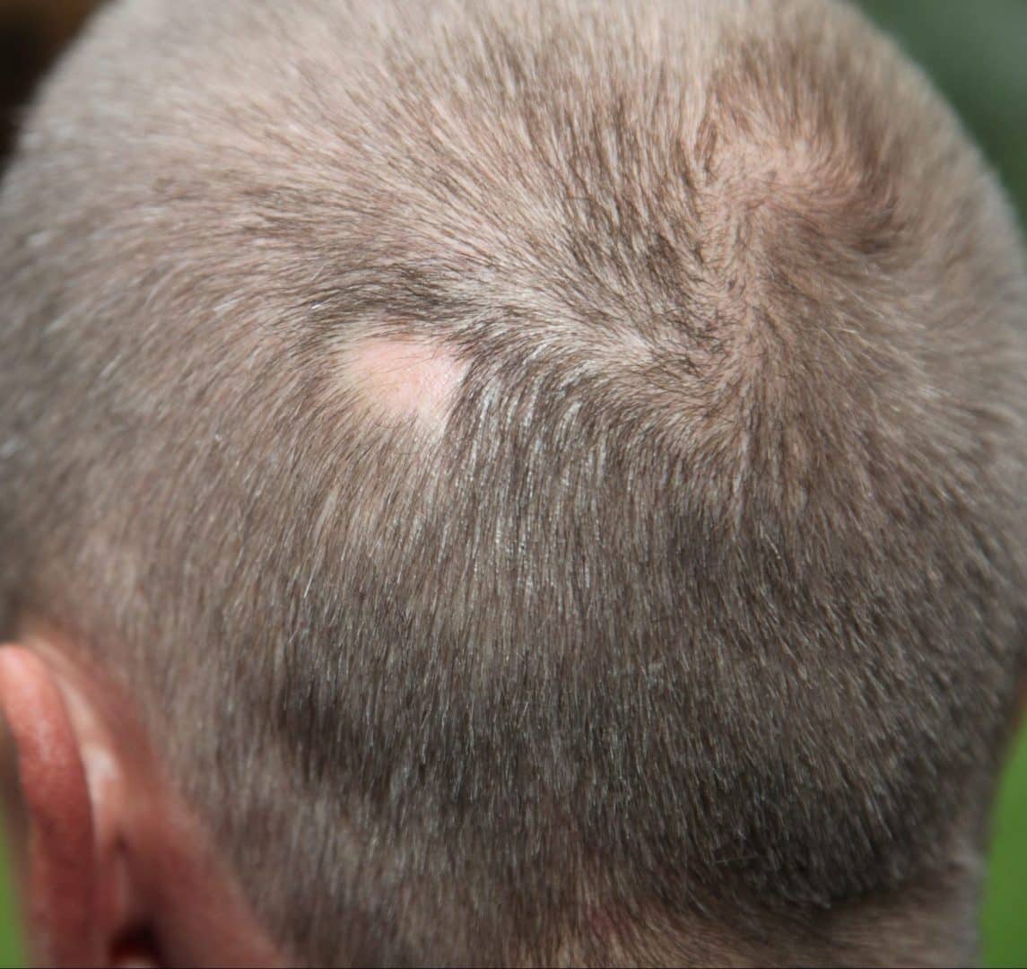 Scalp folliculitis