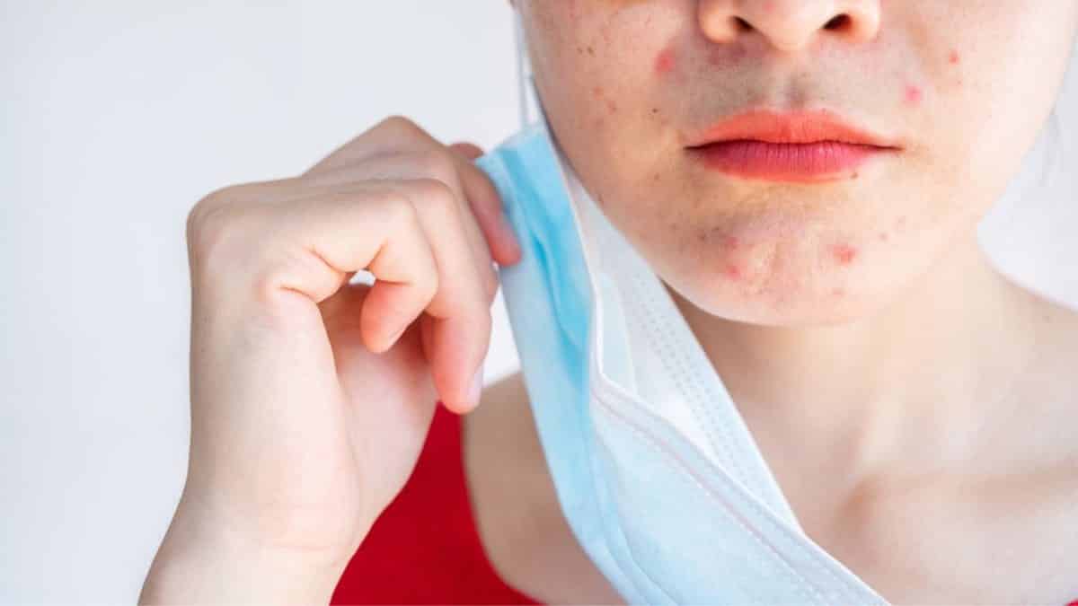 Maskne, what is it?  Tips on how to prevent acne caused by masks