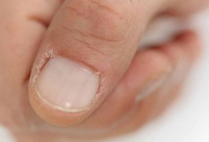 Dry cuticles - Causes and tips on how to avoid dryness