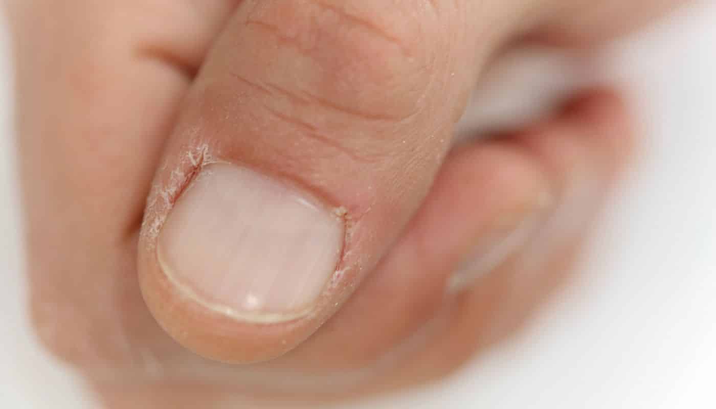 Dry cuticles - Causes and tips on how to avoid dryness