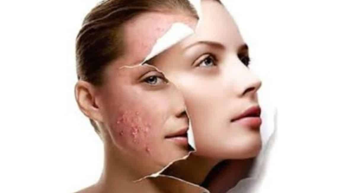 Acne treatments - Types of acne and what to do in each case