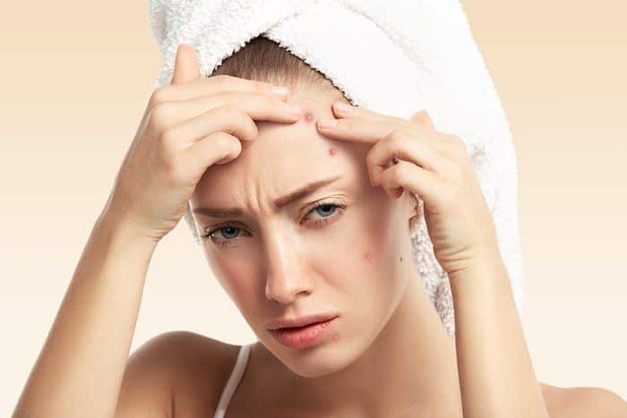 contraceptive for acne