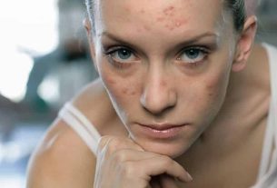 Anticoncepcional para acne - Benefícios e contraindicações