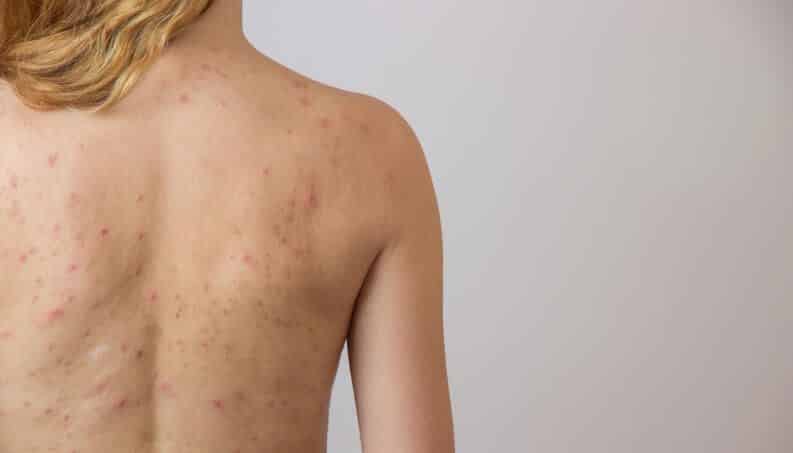 Types of pimples - Differences, treatments and prevention for acne