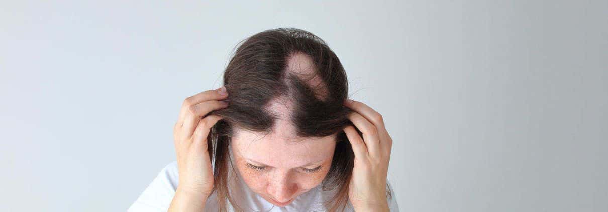 What is alopecia?  - loss of hair