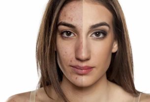 Hormonal pimples - Influence of hormones on the skin