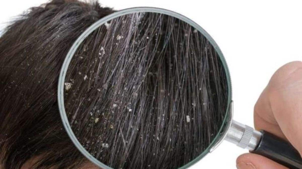 Itchy scalp - Main causes and how to alleviate the discomfort