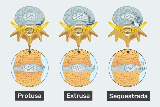 illustration showing the different types of herniated disc