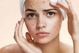 Acne spots - Tips on what to do to lighten and prevent marks