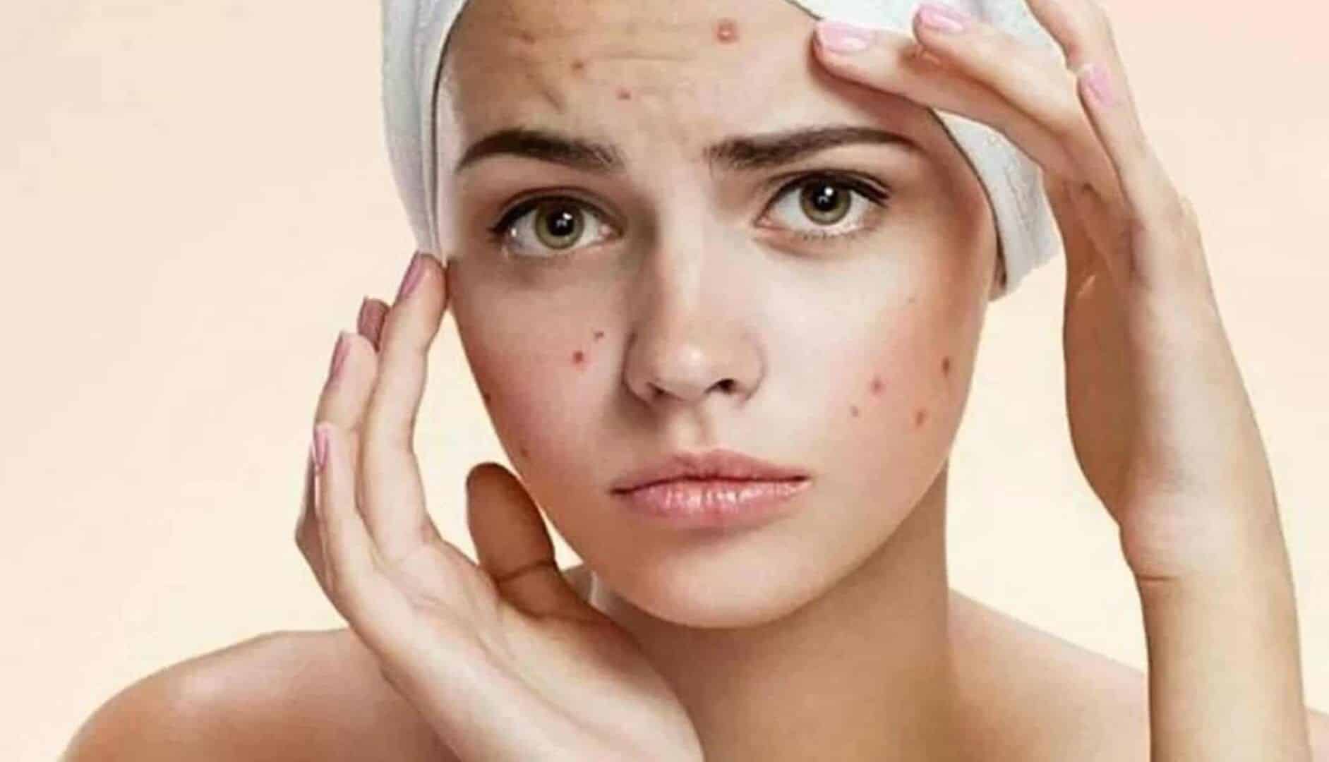 Acne spots - Tips on what to do to lighten and prevent marks