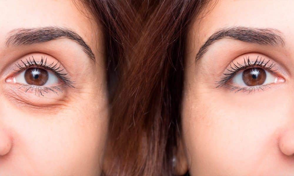 Homemade treatment for dark circles - 4 options to do at home