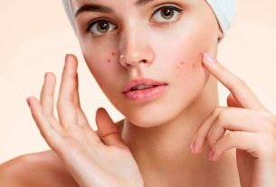 Marcas de acne