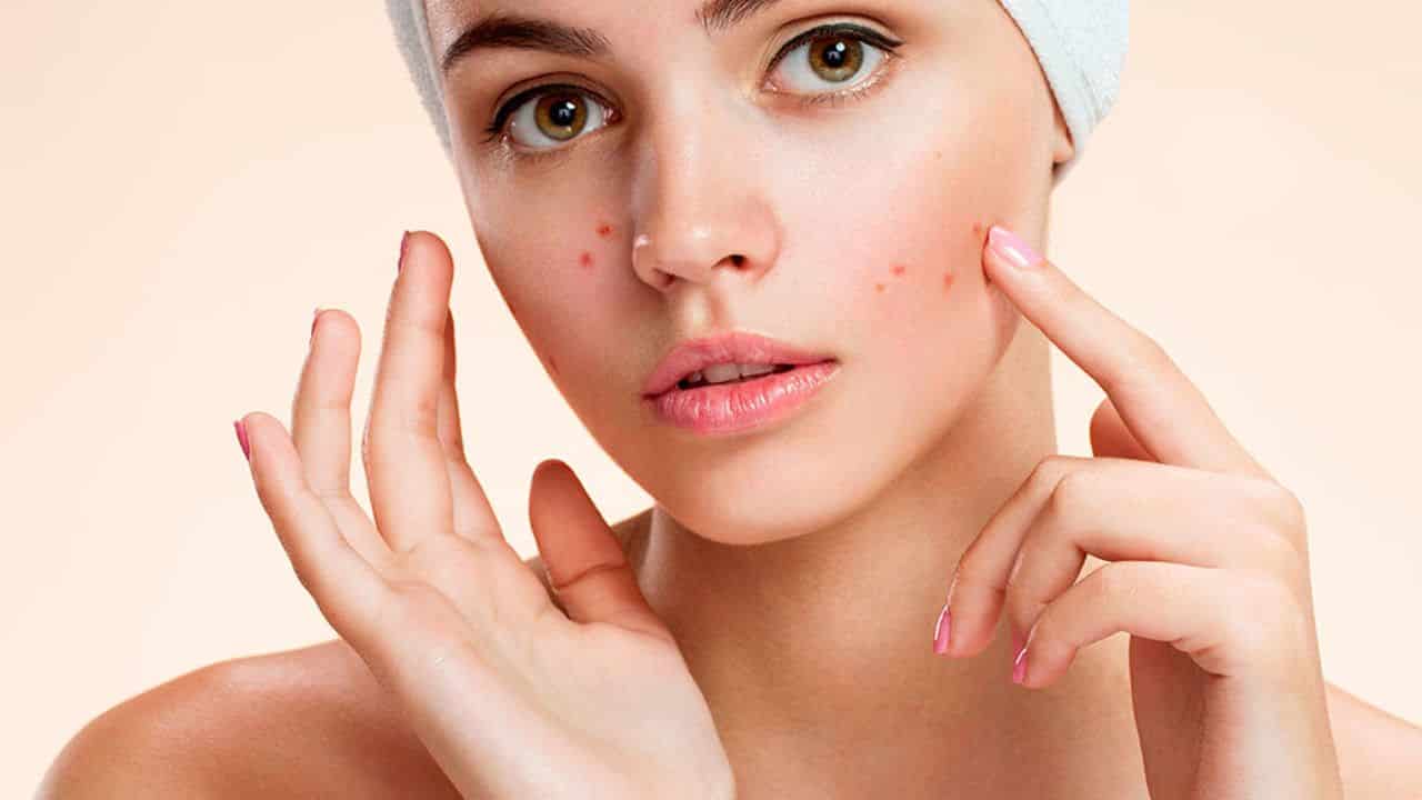 Marcas de acne