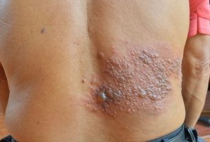 Is shingles contagious?  - Your Health