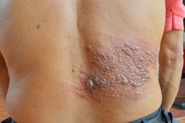 Is shingles contagious?  - Your Health