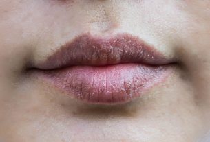 Dry lips – Why it happens and how to keep them hydrated