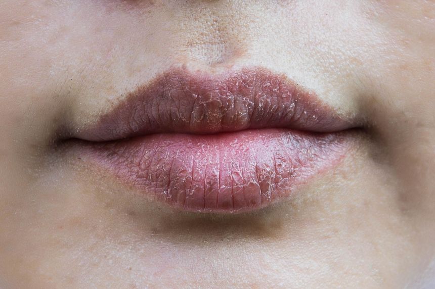 Dry lips – Why it happens and how to keep them hydrated