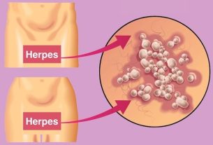 Transmission of genital herpes: how to catch it (and how to avoid it)