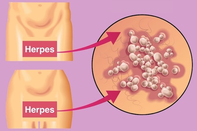 Transmission of genital herpes: how to catch it (and how to avoid it)