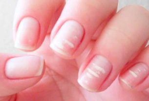 Stained nails – Main causes, treatment and home method