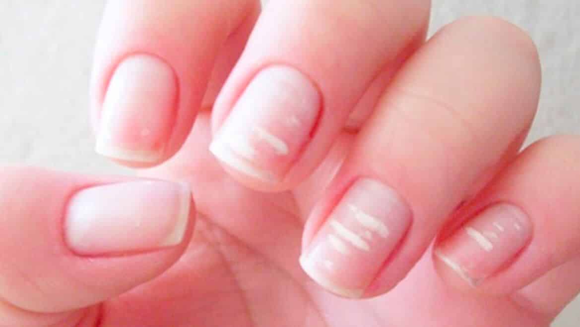 Stained nails – Main causes, treatment and home method