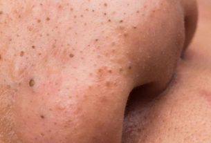 6 ways to eliminate and prevent unwanted spots