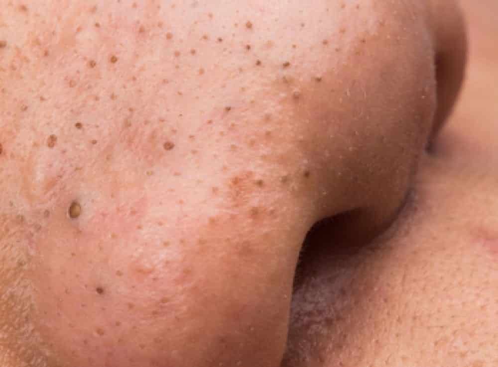 6 ways to eliminate and prevent unwanted spots