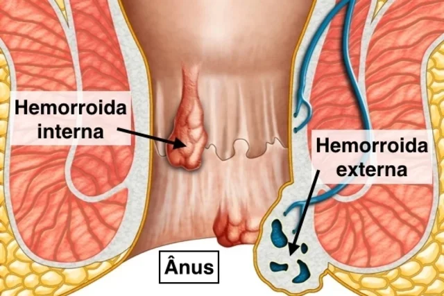 5 Symptome von Hämorrhoiden (und wie man sie behandelt)