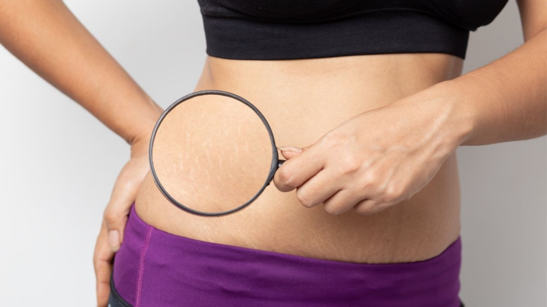 Learn simple tricks to hide cellulite and stretch marks