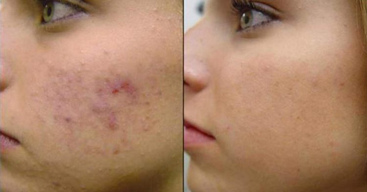 Tips to eliminate pimple spots