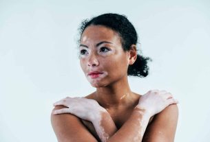 5 dicas de skincare para pele com vitiligo