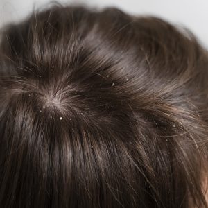 7 Steps To Control Dandruff During Winters