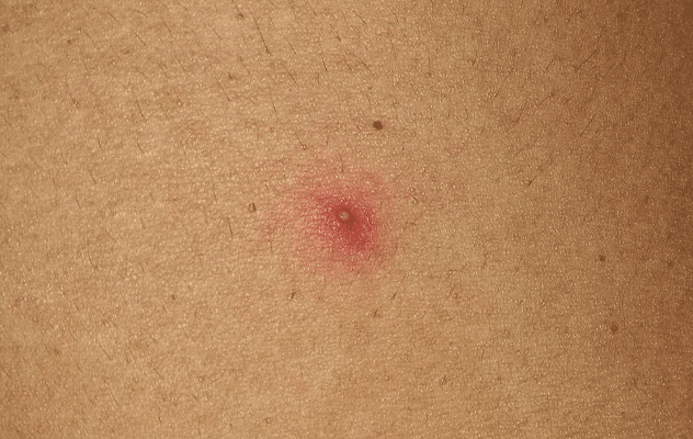 Folliculitis