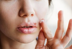 Cold sores: what it is, symptoms, causes and treatment