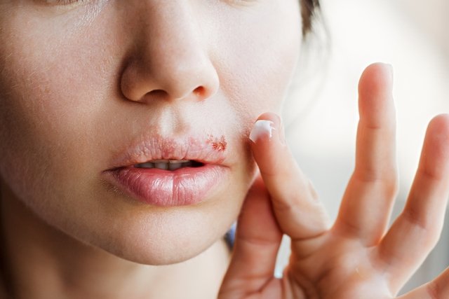 Cold sores: what it is, symptoms, causes and treatment