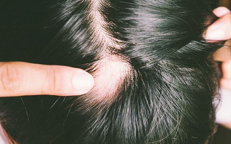 What is alopecia?  - loss of hair