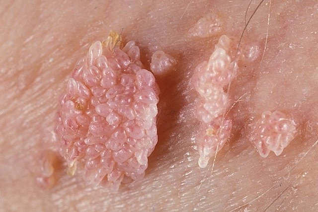 Photo of genital warts