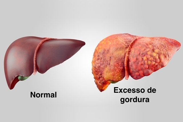 Hepatic steatosis: what it is, degrees, symptoms and treatment