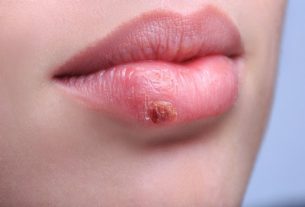 How do you catch herpes (labial, genital and shingles) and how to protect yourself