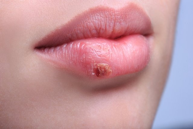 How do you catch herpes (labial, genital and shingles) and how to protect yourself