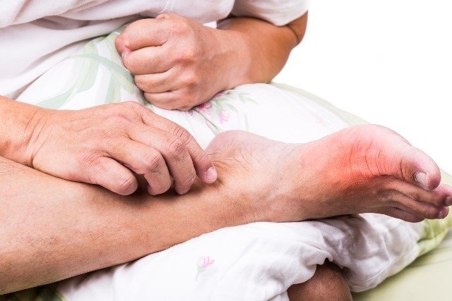 How to treat Gout: most used remedies