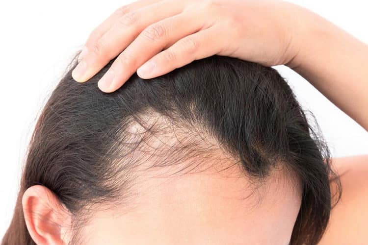 Female pattern baldness: how to identify, causes and types of treatments