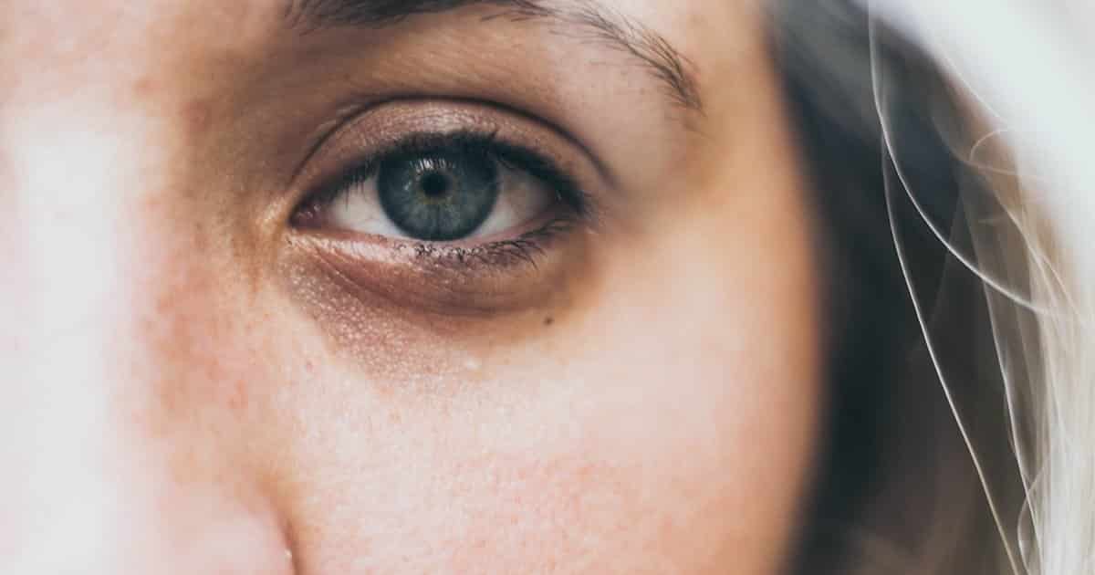 Deep dark circles: find out the causes and how to treat them