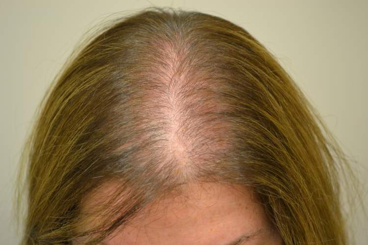 Discover the main causes of hair loss