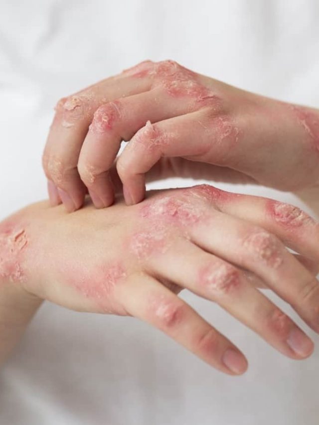 Psoriasis Diet: What To Eat And What Not To Eat