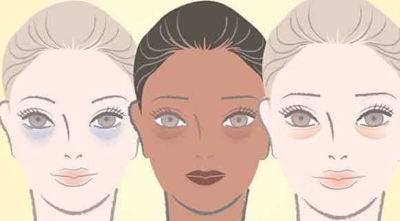 What causes dark circles?  Discover the 4 types and learn how to treat them