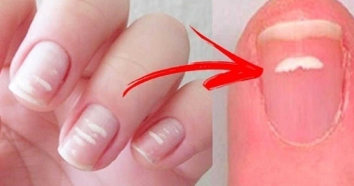 White spot on the nail: find out the causes, treatment and home remedy